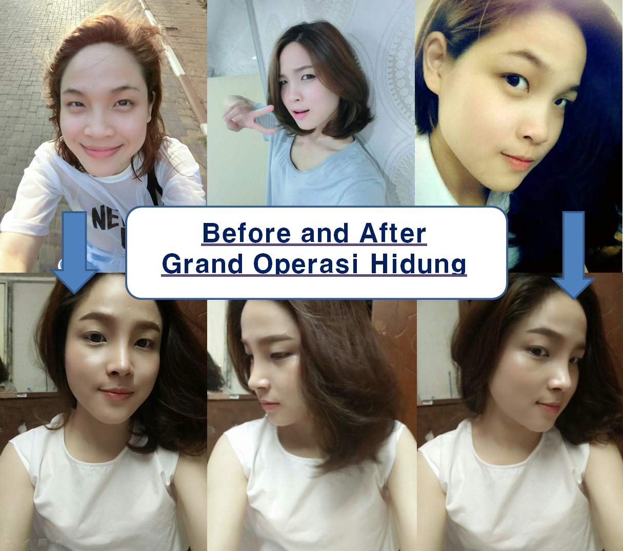 Operasi Hidung Grand Plastic Surgery